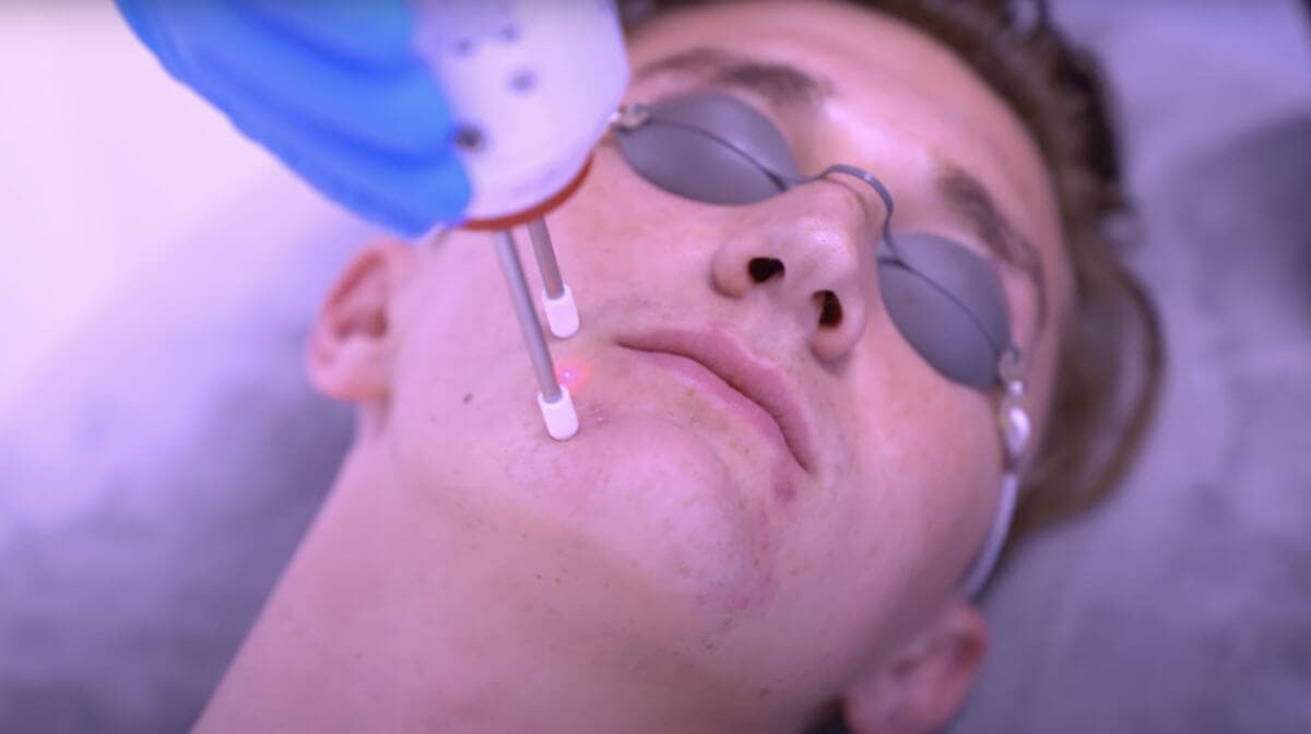 Laser dermatology treatment for adult acne and general scarring by Dr. Jason Emer