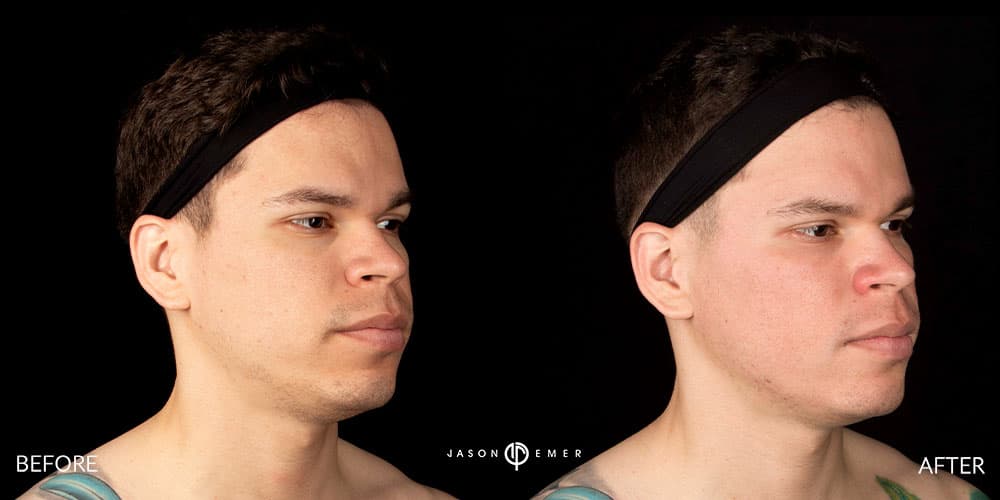 Acne-Scar-Male-Before-After-Beverly-Hills-2