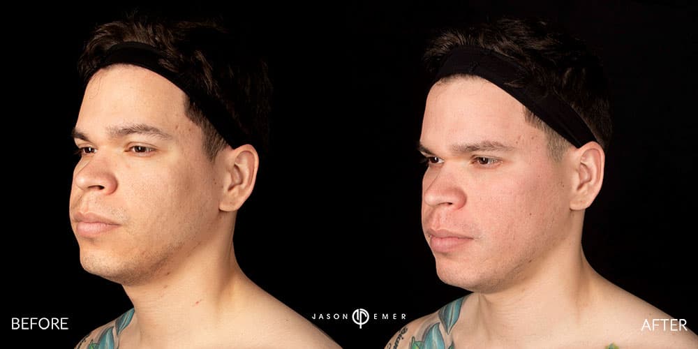 Acne-Scar-Male-Before-After-Beverly-Hills-3