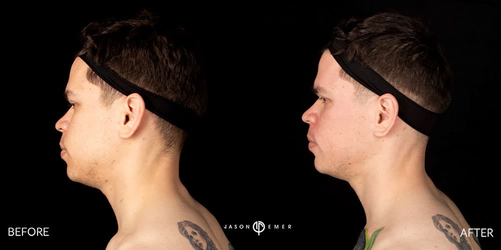 Acne-Scar-Male-Before-After-Beverly-Hills-4