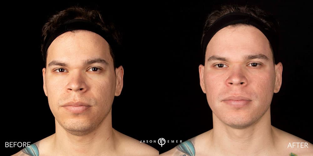 Acne-Scar-Male-Before-After-Beverly-Hills-5