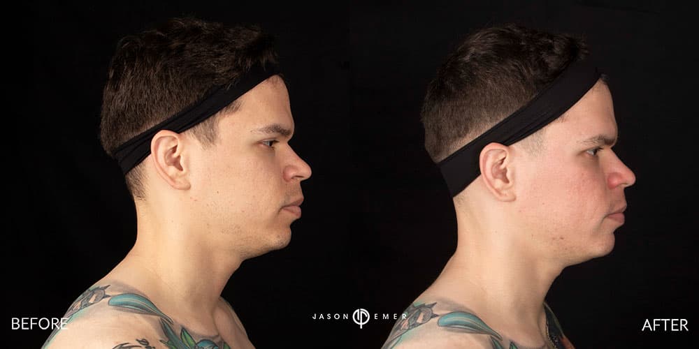 Acne-Scar-Male-Before-After-Beverly-Hills-6