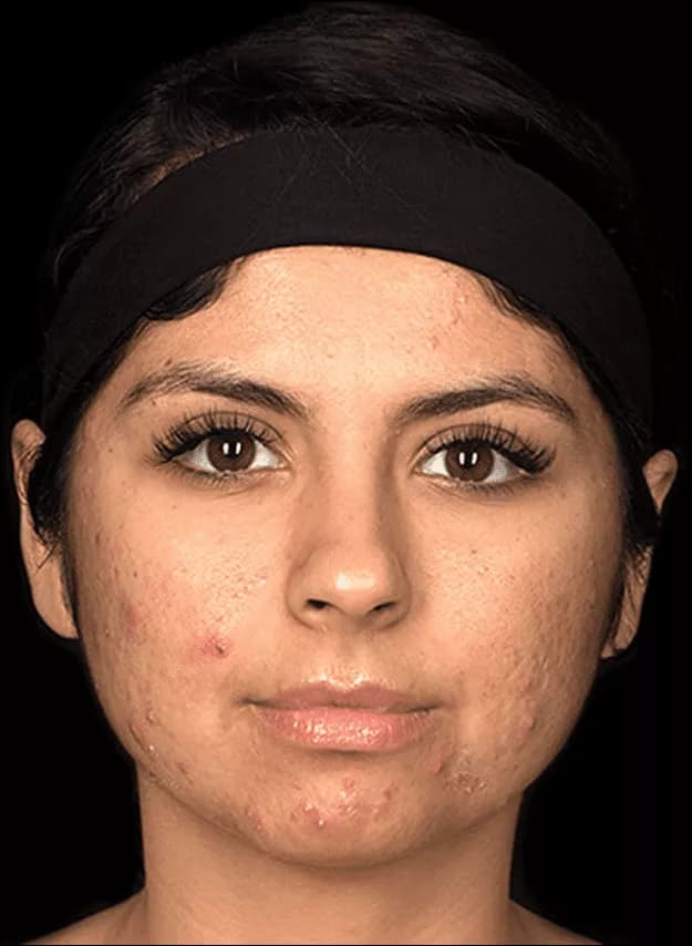 Female keloid scar reference