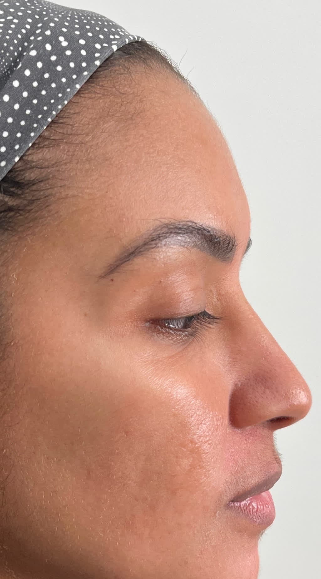 Acne Scar