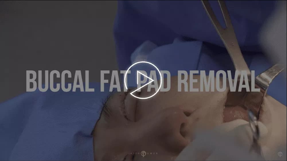 BUCCAL FAT REMOVAL FOR WOMEN