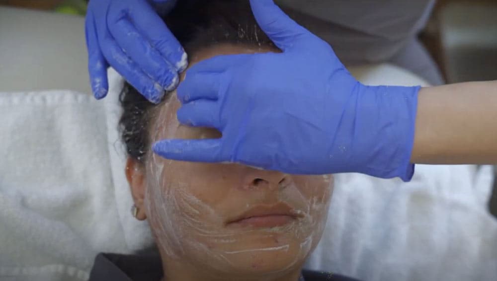 CHEMICAL PEELS