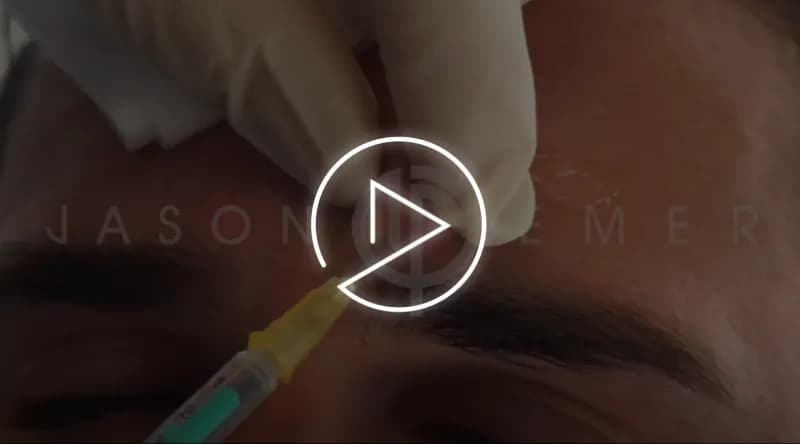 Male brow and forehead rejuvenation result