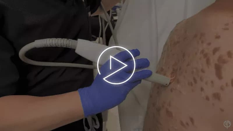 Keloid Treatment