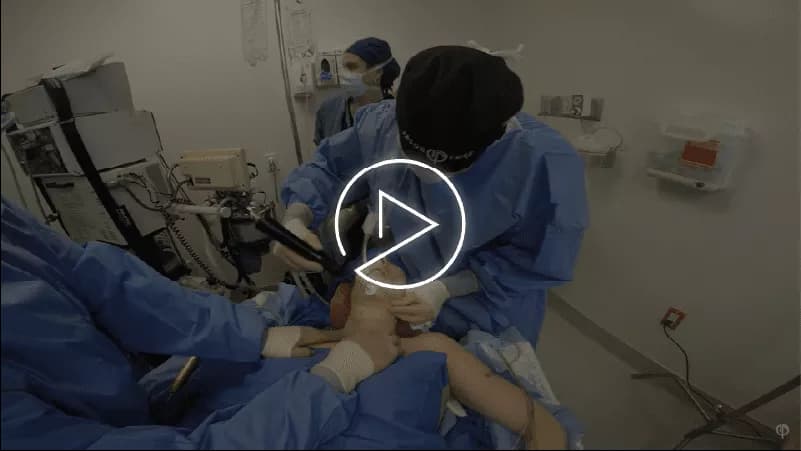 FACE AND NECK LIPO FOR WOMEN