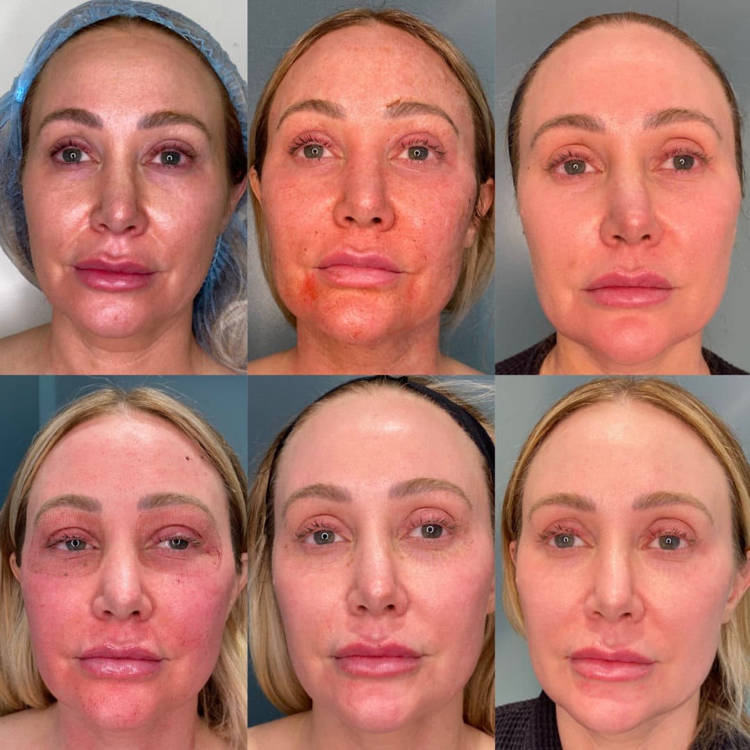 Facial Sculpting