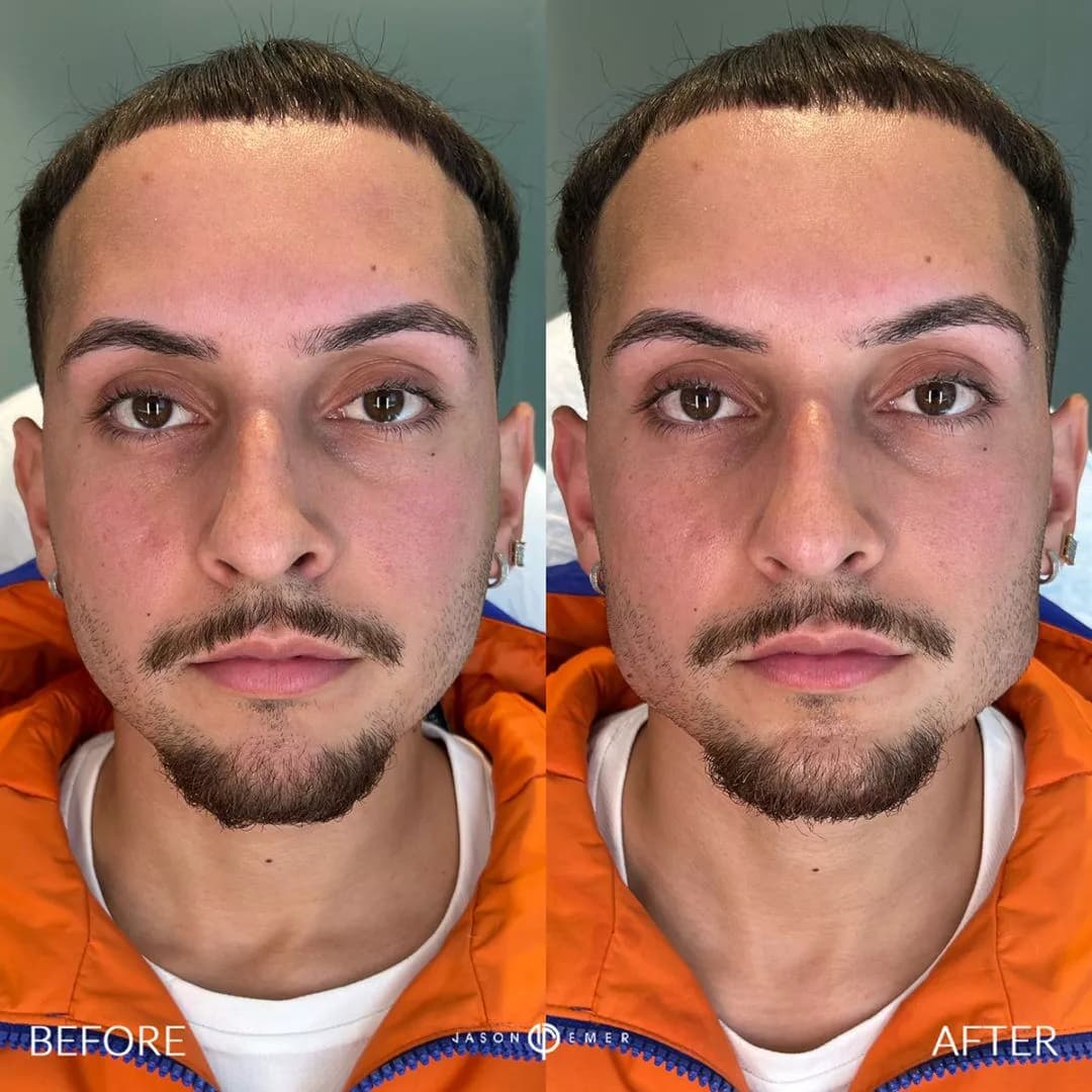 Male facial sculpting result reference