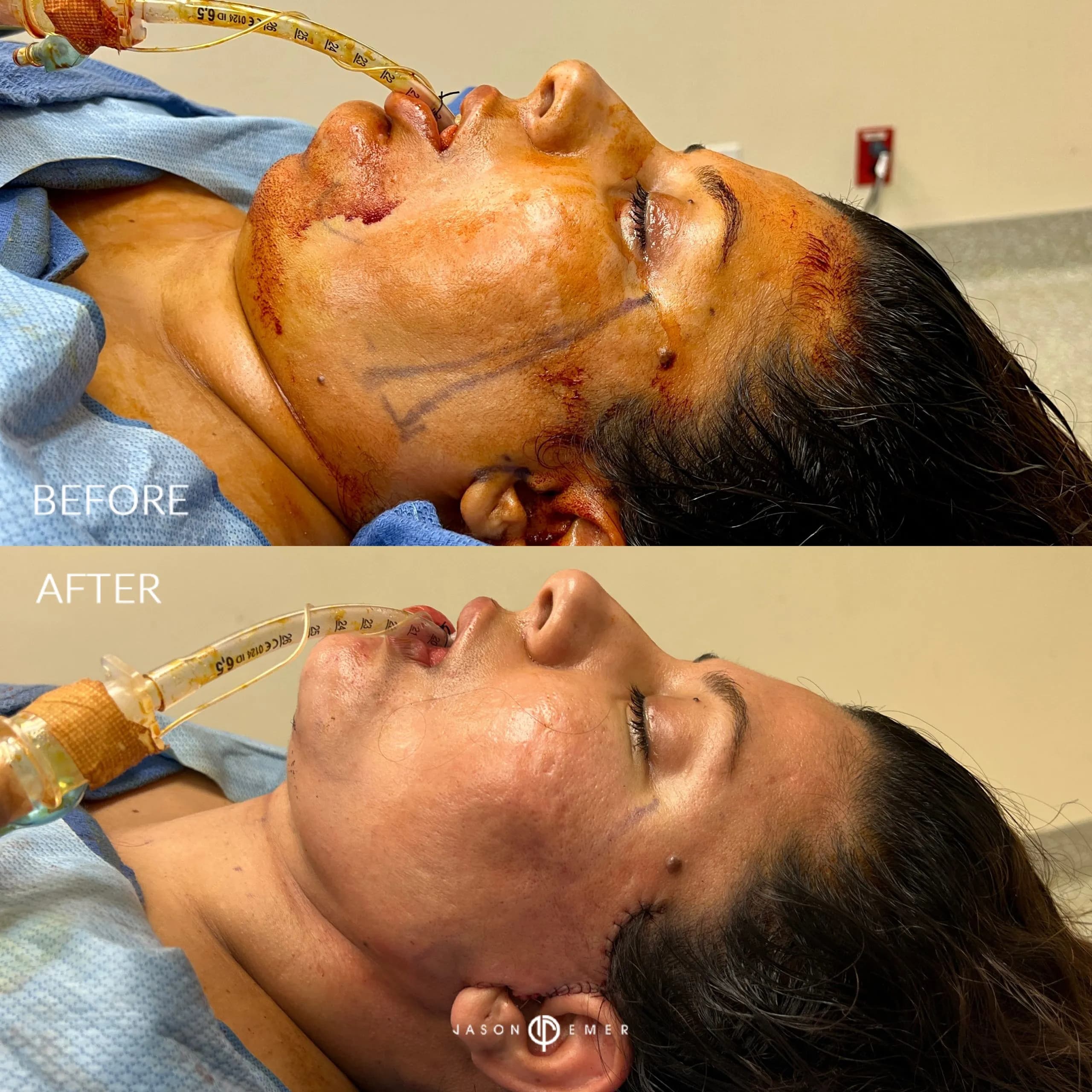 Female face and neck lift patient result