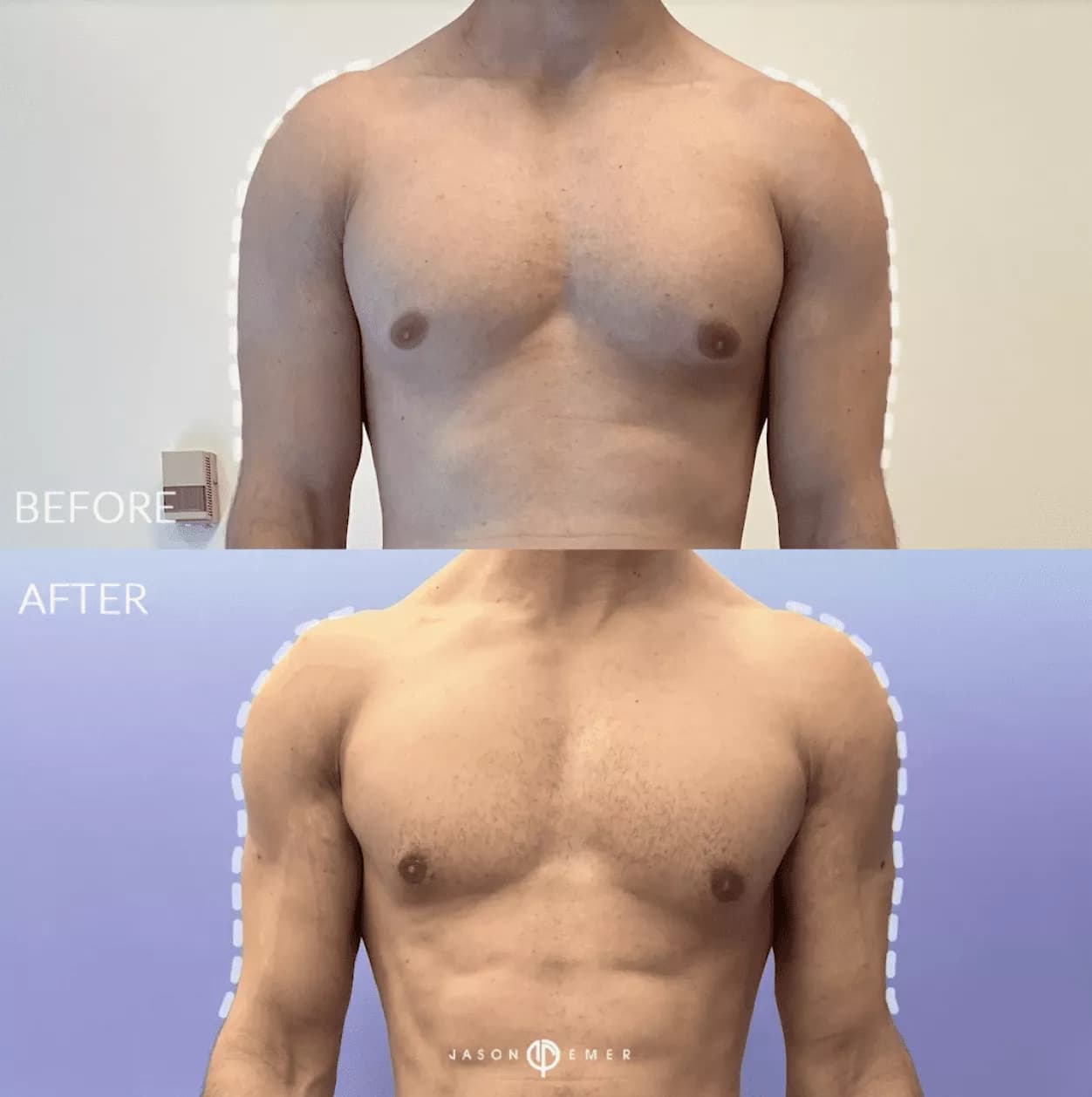 Dr. Jason Emer, board-certified dermatologist who performs Gladiator Lipo