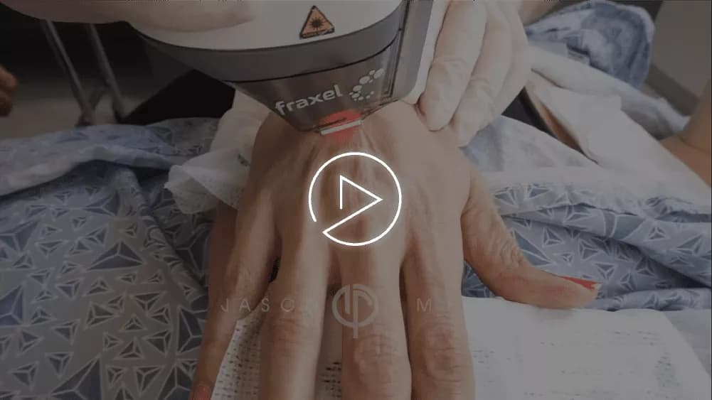 HAND REJUVENATION