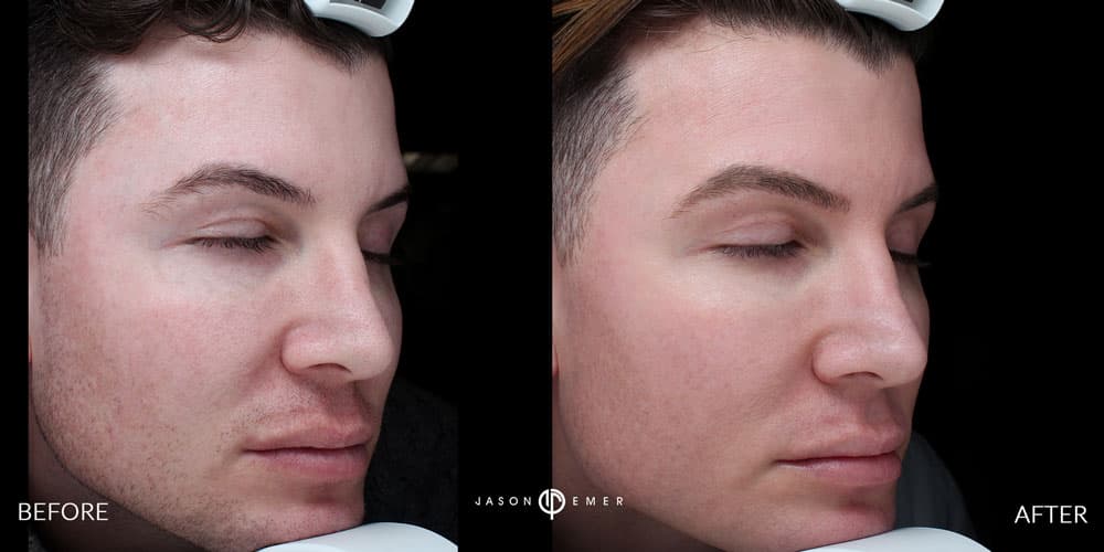 Male-Acne-Scar-Treatment-Before-and-After-Los-Angeles-1