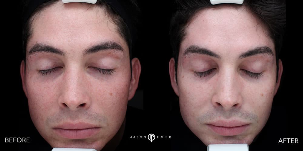Male-Acne-Scar-treatment-Los-Angeles-2