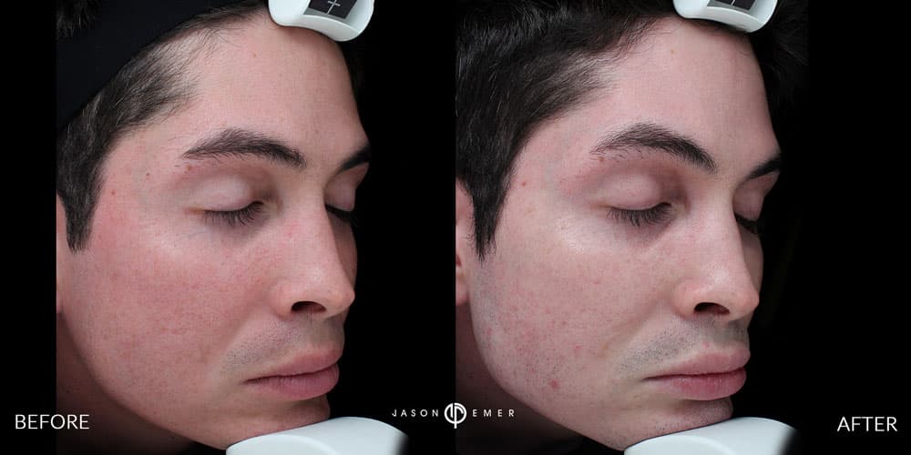 Male-Acne-Scar-treatment-Los-Angeles-3