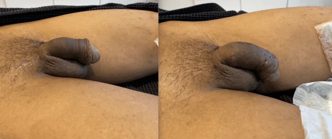 Penile Enhancement