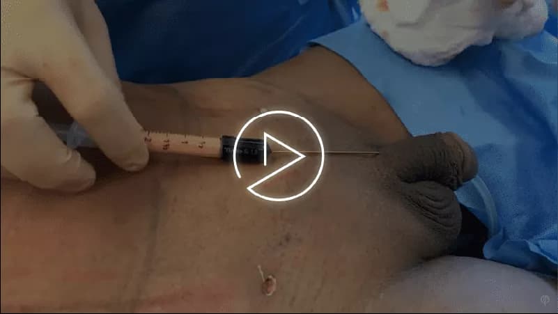Penile Enlargement with Fat Grafting