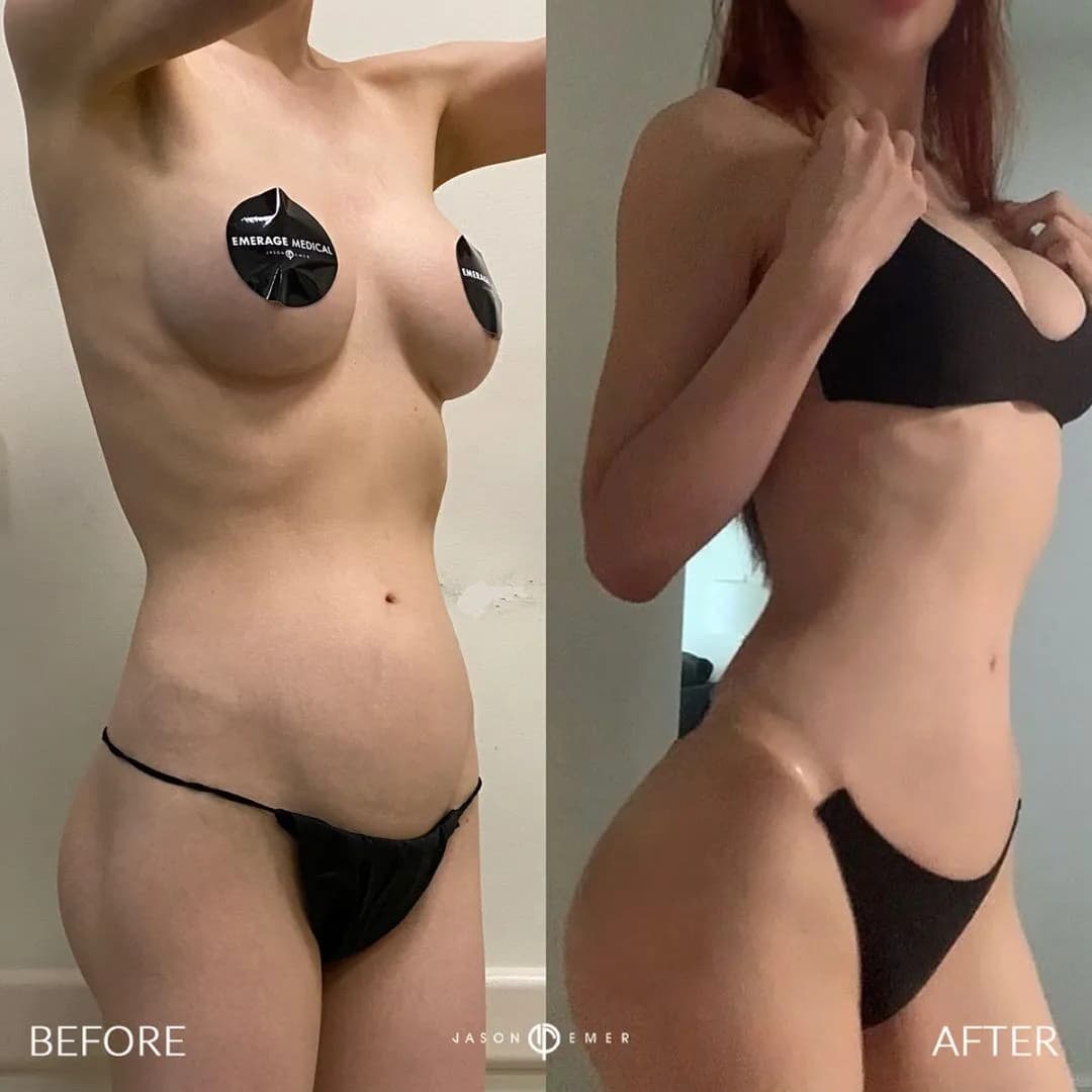 Non Surgical BBL with Butt Injections for Natural Curve Enhancement before and after by Dr. Jason Emer in Beverly Hills