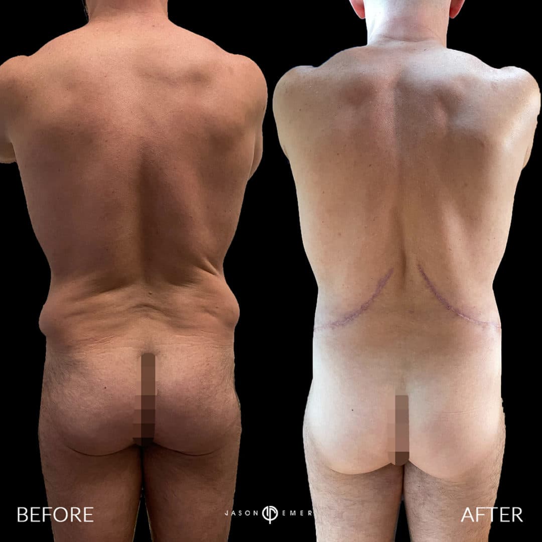 Back Liposuction LP before and after by Dr. Jason Emer in Beverly Hills