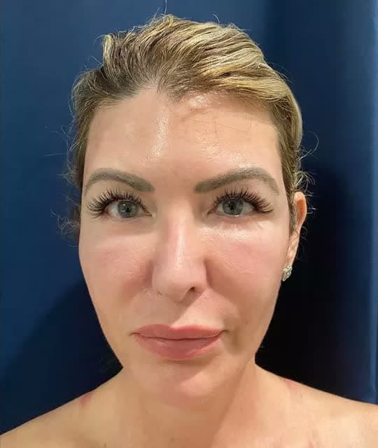 SKIN TIGHTENING