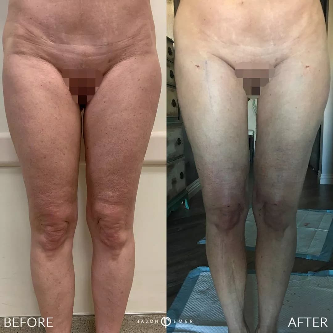 Dr. Jason Emer, board-certified dermatologist who performs Thigh Liposuction