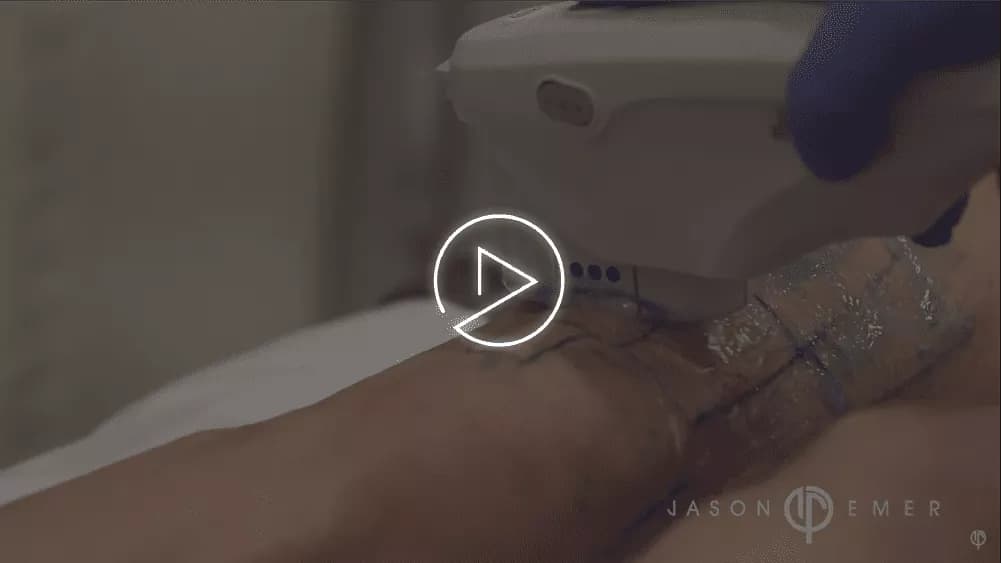 Ultherapy