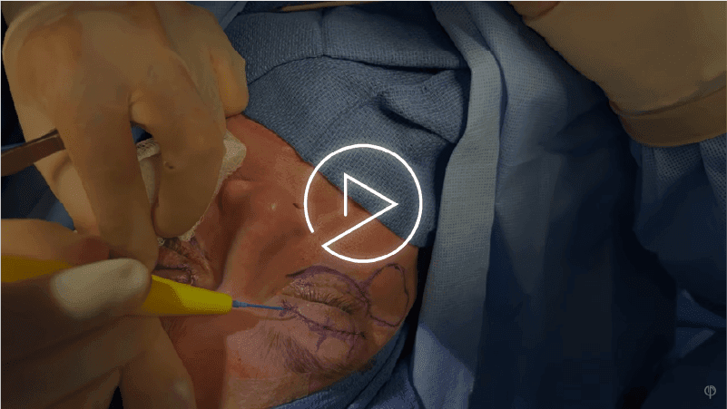 Upper blepharoplasty (eyelid surgery) result