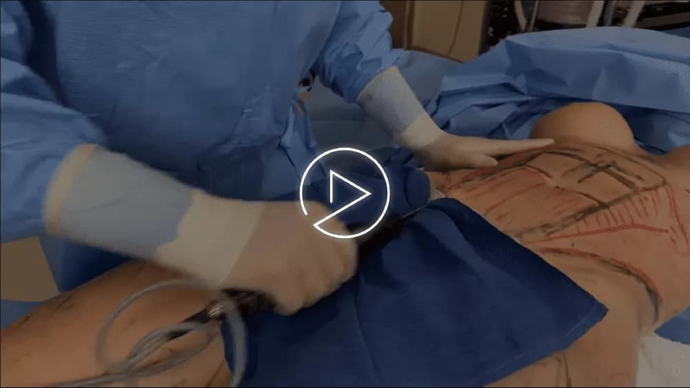 Vaser Liposuction