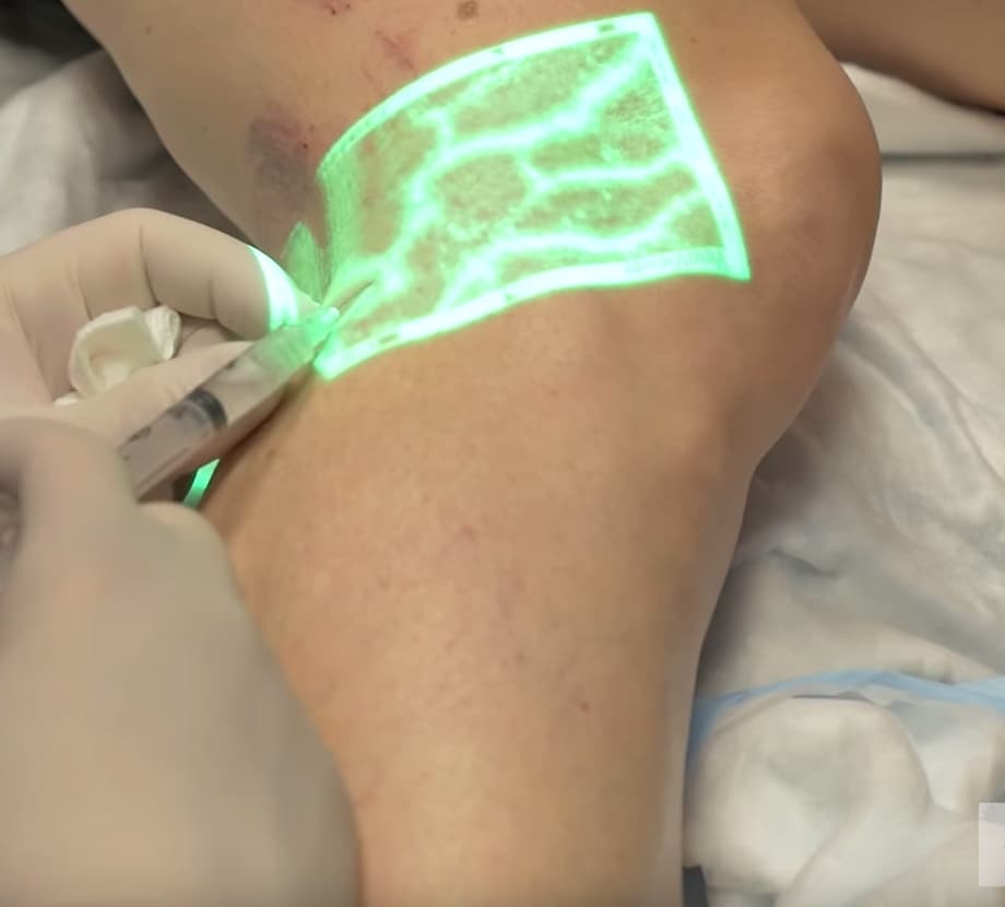 vein treatment