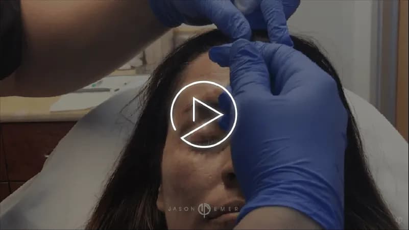 Xeomin Treatment for Wrinkle Reduction and Facial Rejuvenation