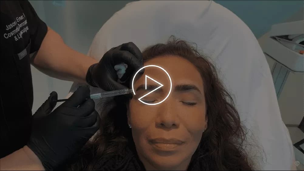 Direct brow lift editorial result