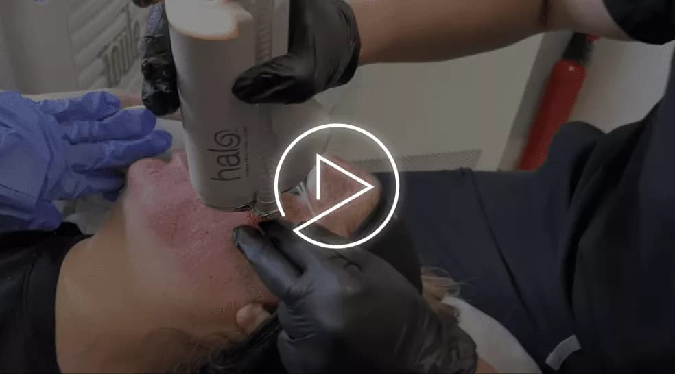 Halo Laser Treatment for Radiant, Rejuvenated Skin