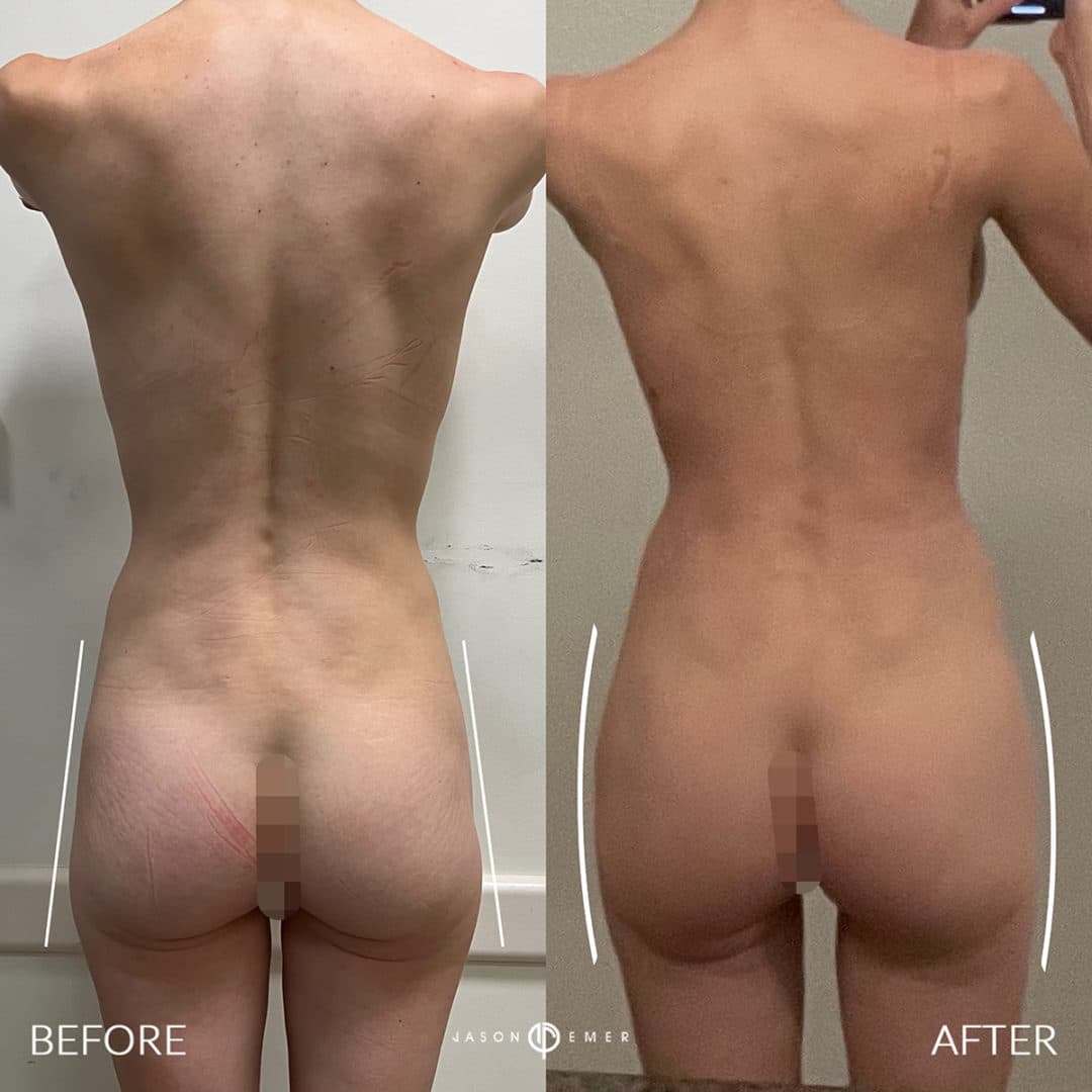 Dr. Jason Emer, board-certified dermatologist who performs Hip Augmentation