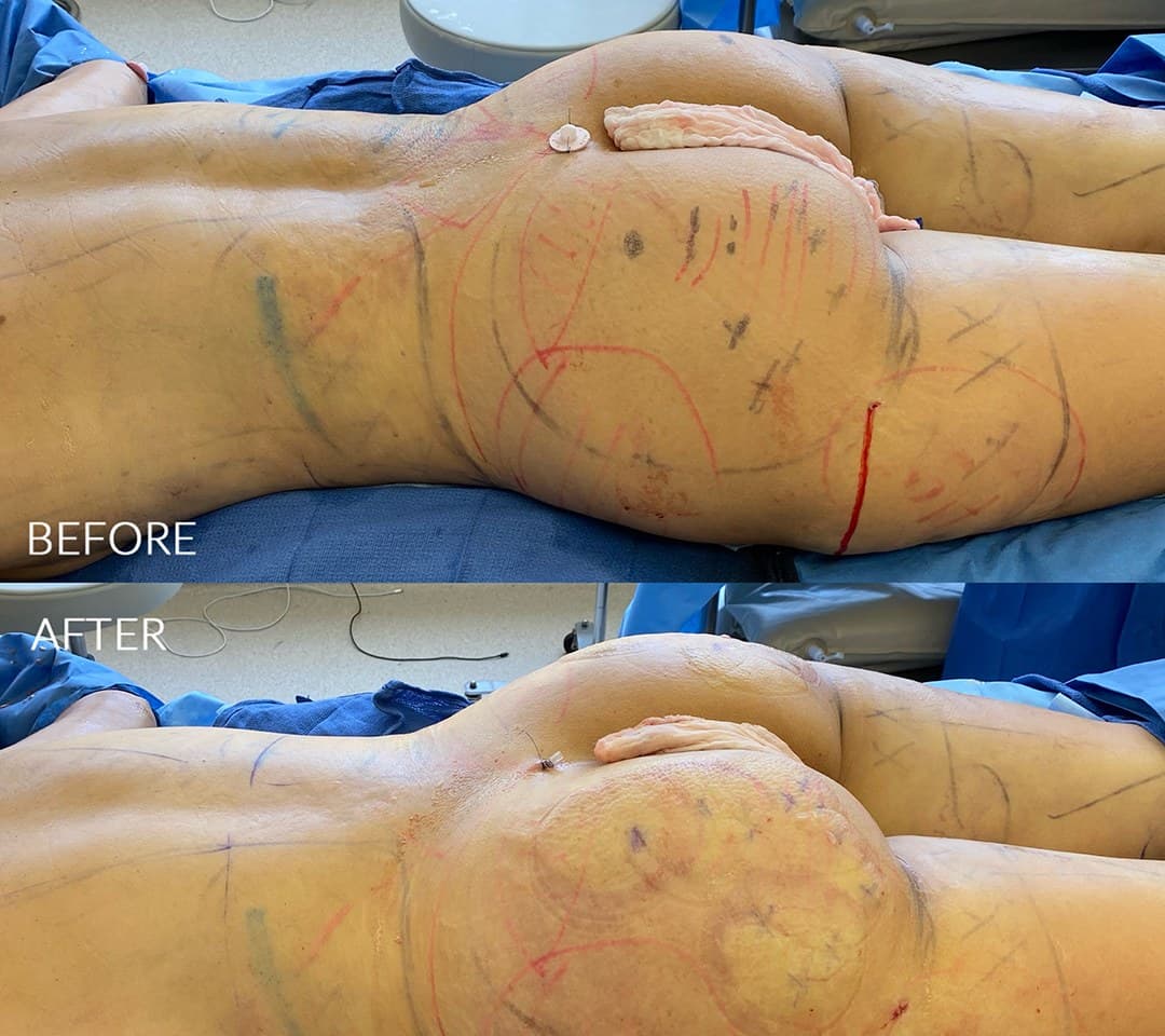 Female 360 HD Liposculpture before and after by Dr. Jason Emer in Beverly Hills