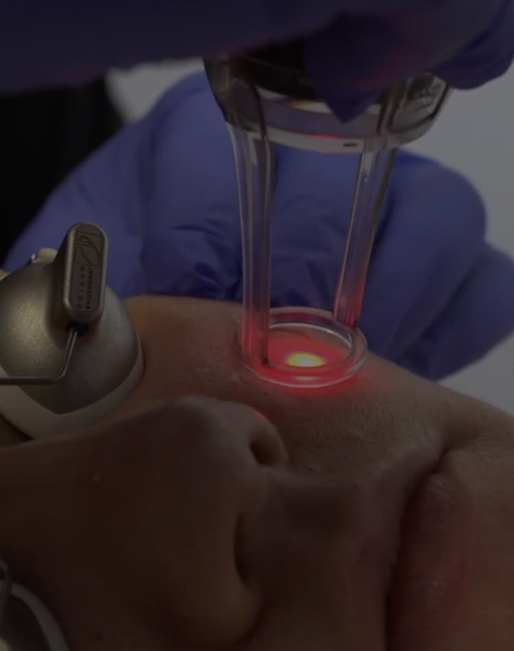 Cosmetic laser dermatology treatment for adult acne and skin rejuvenation by Dr. Jason Emer