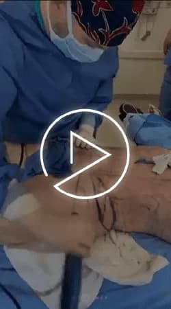 Mons Pubis Liposuction