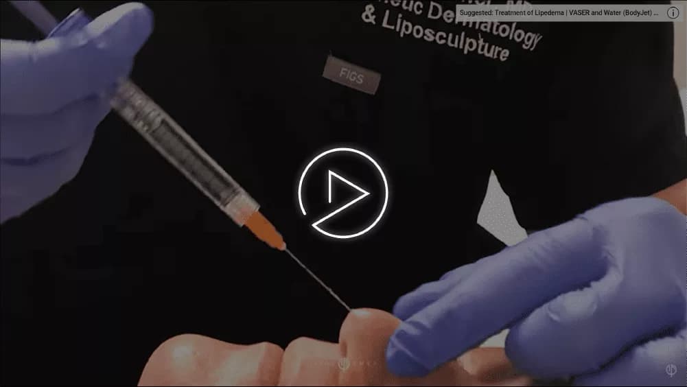 Alar base reduction rhinoplasty result
