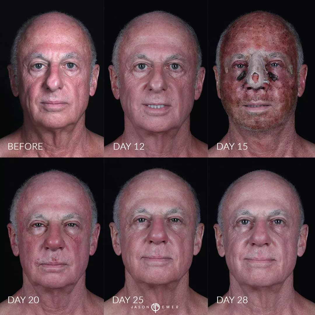 Gender-affirming rhinoplasty result