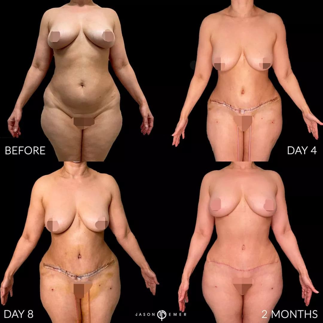 Four-panel before, day 4, day 8, and 2 month body-contouring result timeline