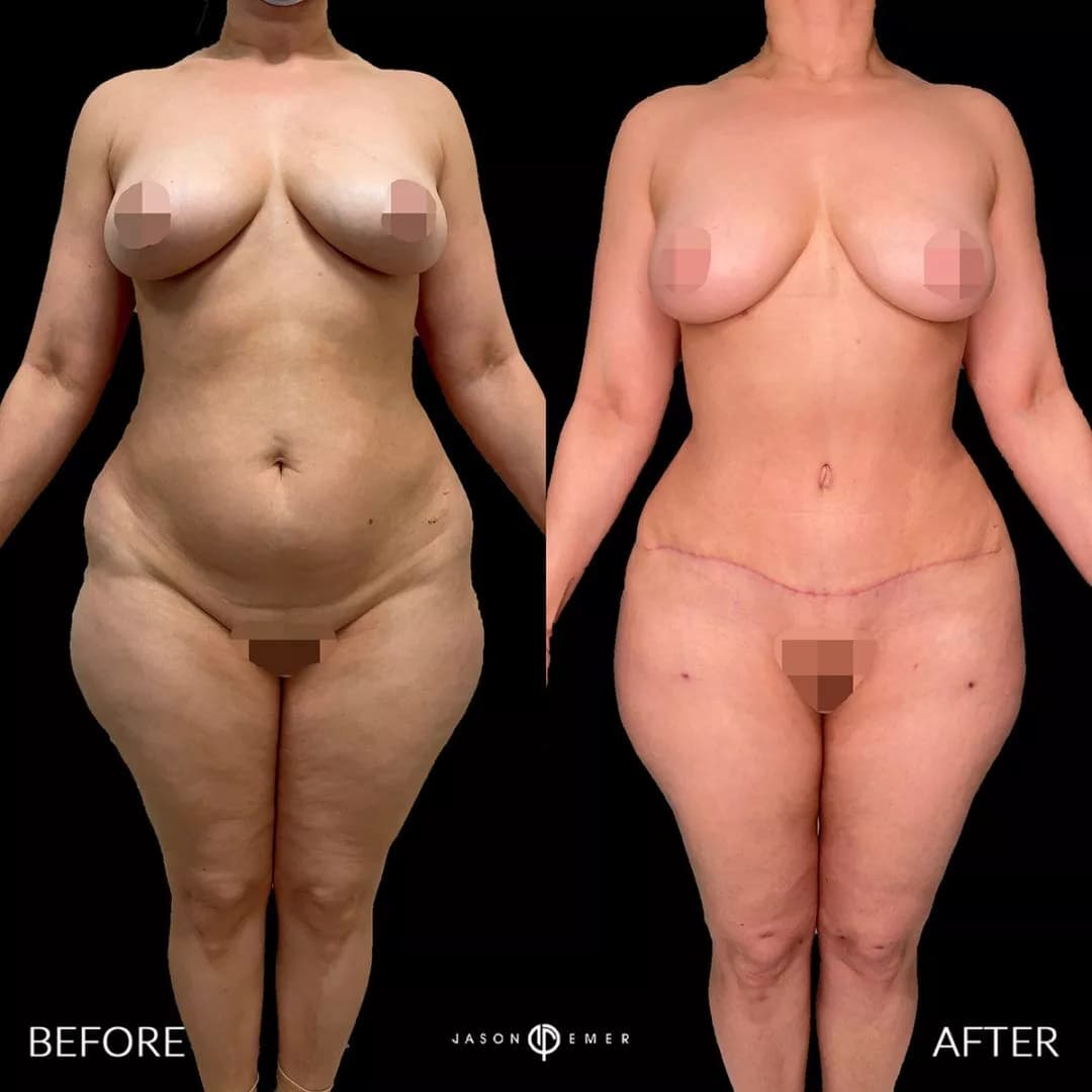 Editorial full-figure before-and-after of a surgical body refinement result