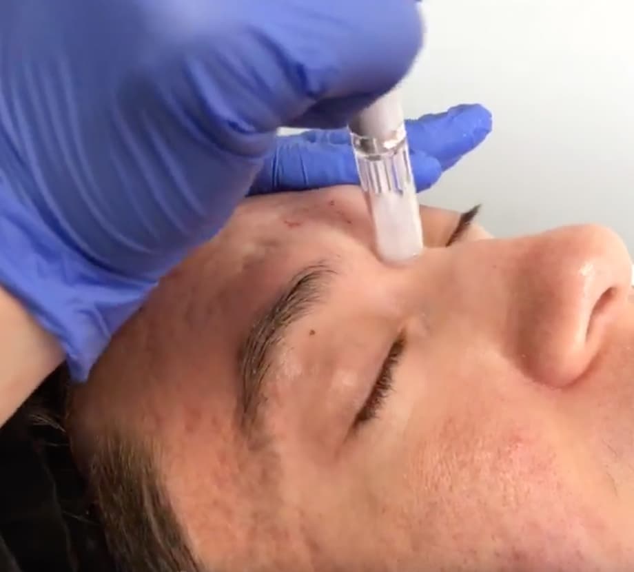 vampire facial
