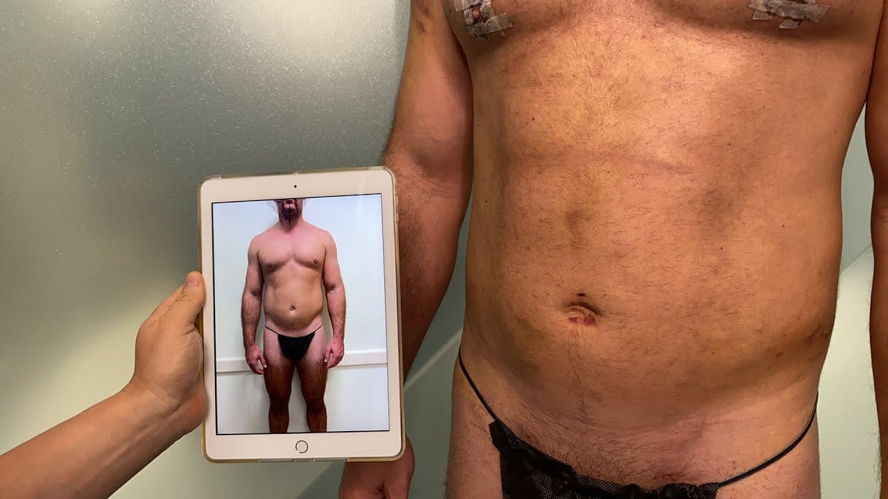 Watch a arm liposuction procedure video