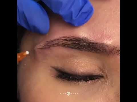 Watch a brow lift procedure video