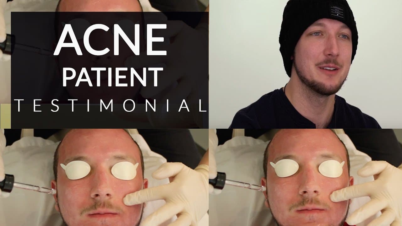 Microneedling procedure video