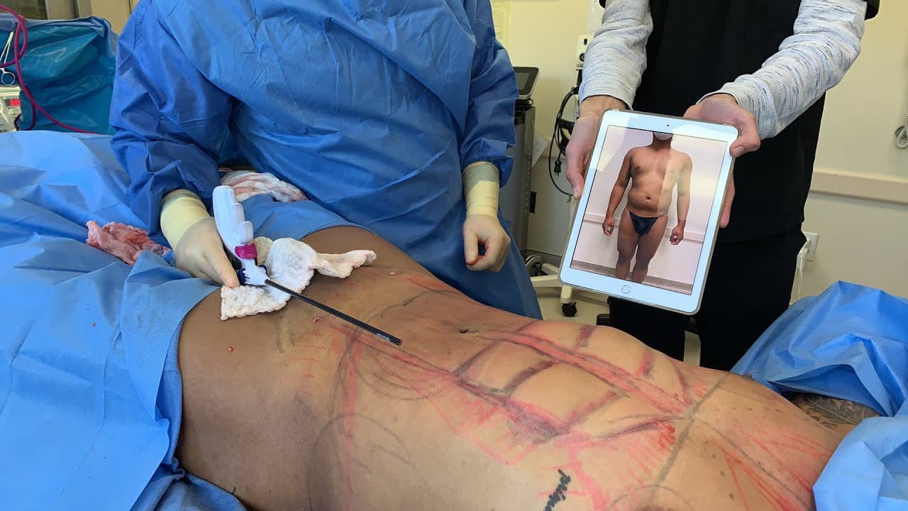 Watch a abdominal lipo for men procedure video