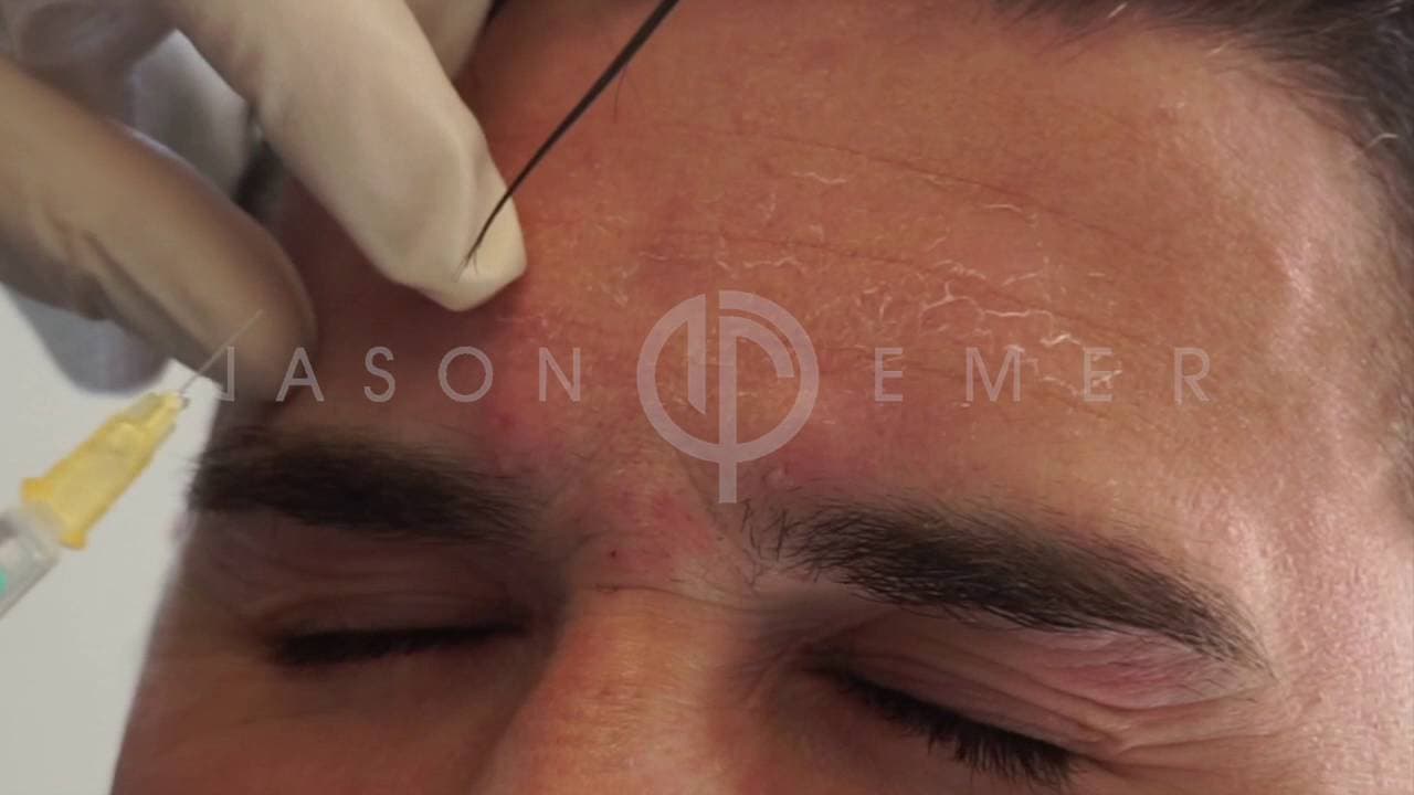 Watch a dysport procedure video