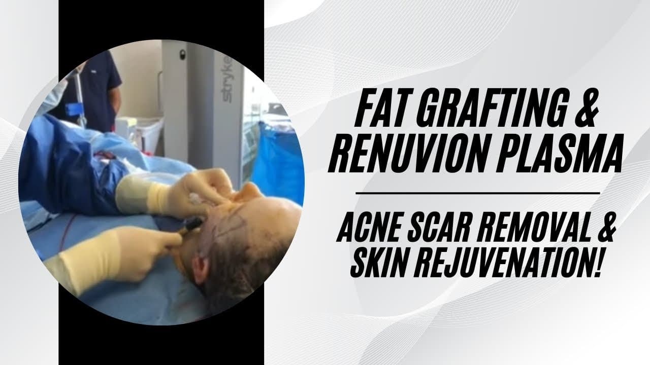 Watch a autologous fat grafting provides permanent volumization, shaping, sculpting, and muscular definition enhancements procedure video