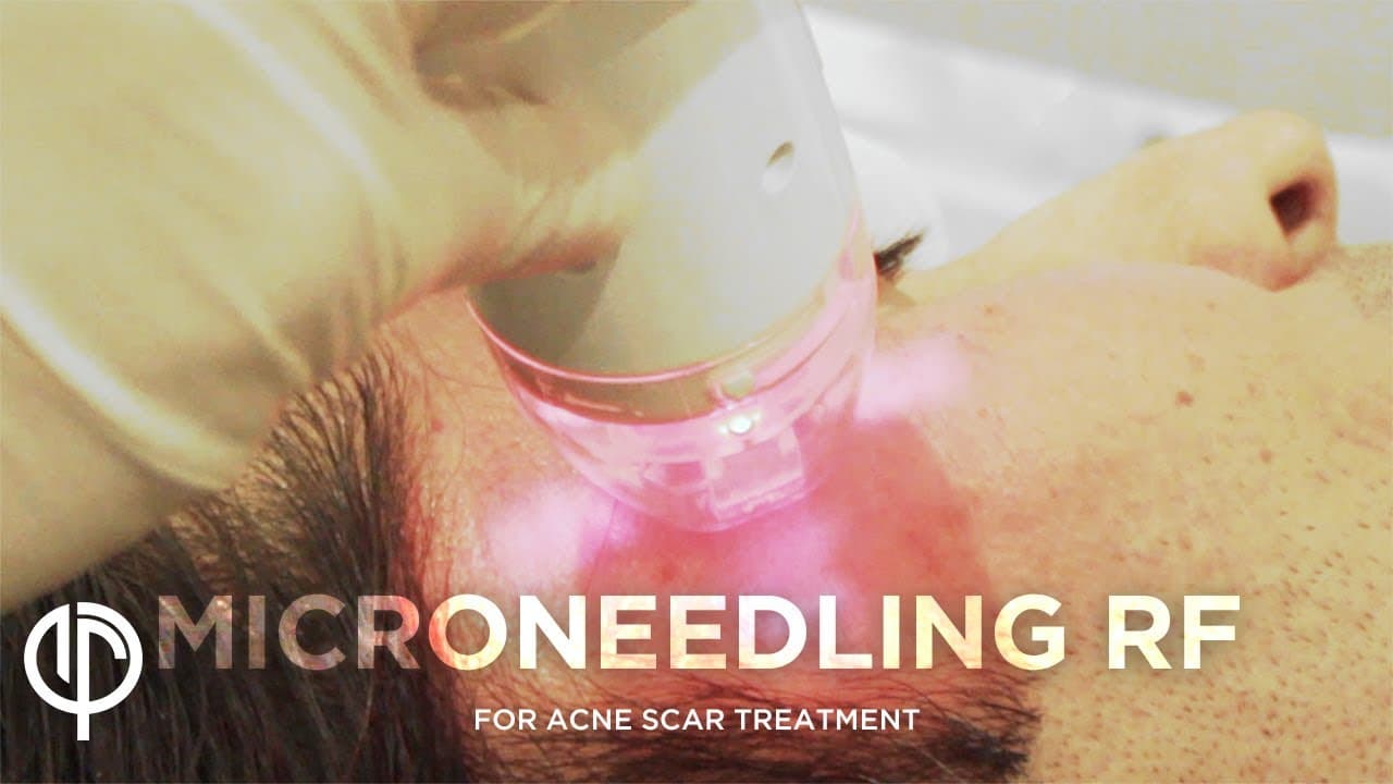 Microneedling procedure video